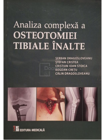 Serban Dragosloveanu - Analiza complexa a osteotomiei tibiale inalte - 2017 - Brosata