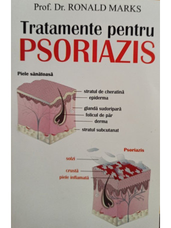 Tratamente pentru psoriazis