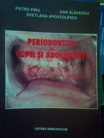 Periodontita la copii si adolescenti