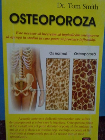 Osteoporoza