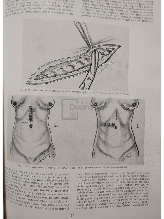 Tehnici chirurgicale, vol. II - Chirurgia cailor biliare extrahepatice